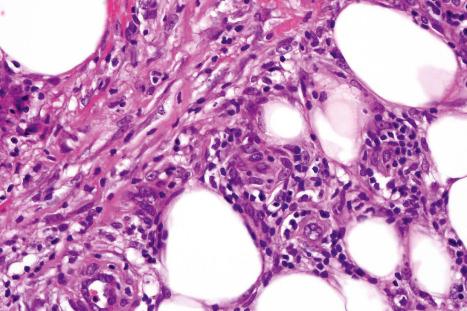 Fig. 10.14, Erythema nodosum: close-up view of cellular infiltrate.