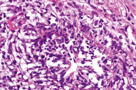 Fig. 10.15, Erythema nodosum: collections of histiocytes known as Miescher granulomata are a common finding. Fibrinoid necrosis affecting a small venule is also present.