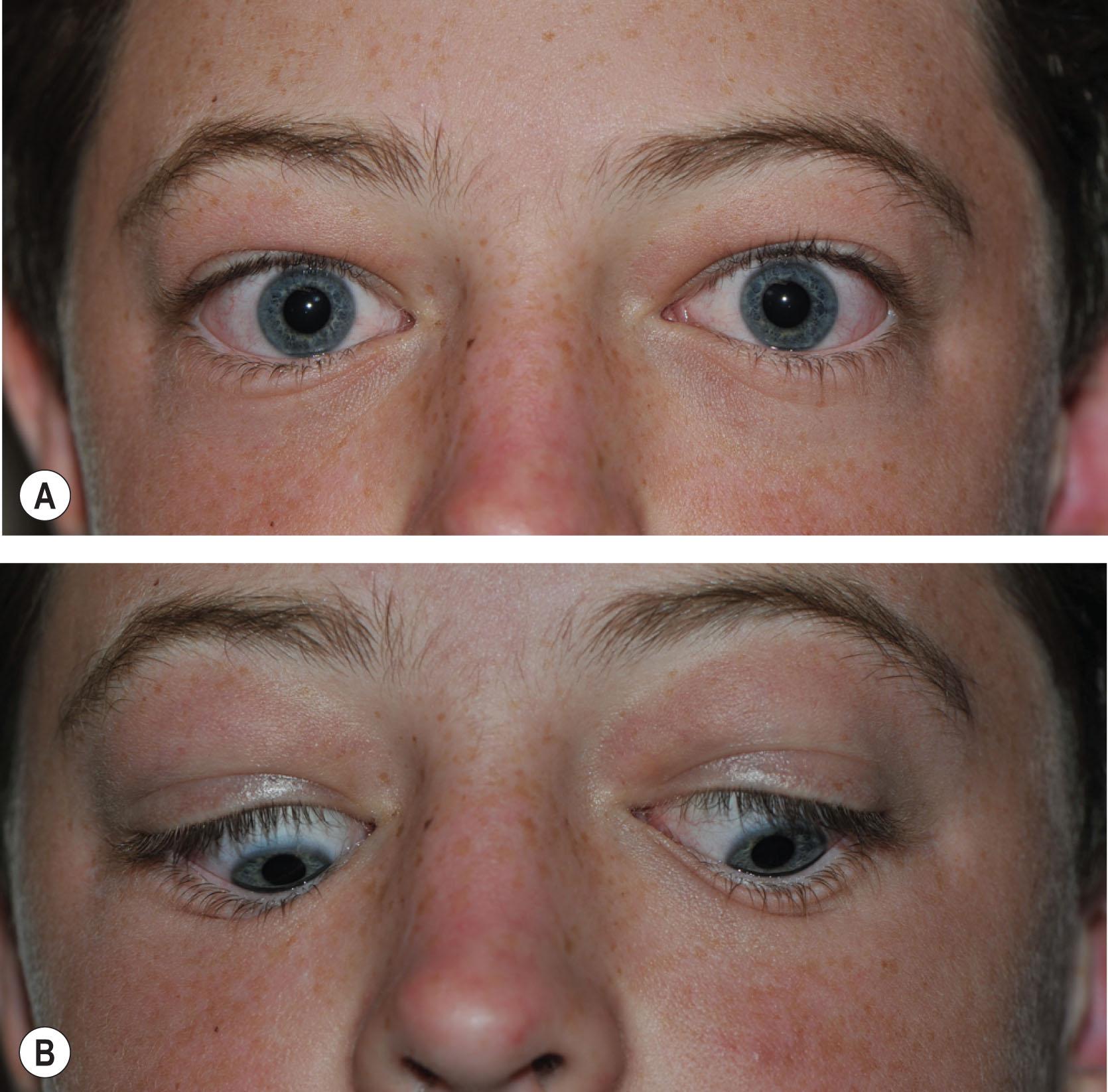 Fig. 28.2, A 14-year-old boy with active thyroid-associated orbitopathy has bilateral asymmetric upper eyelid retraction (A), with lid lag on downgaze (B).