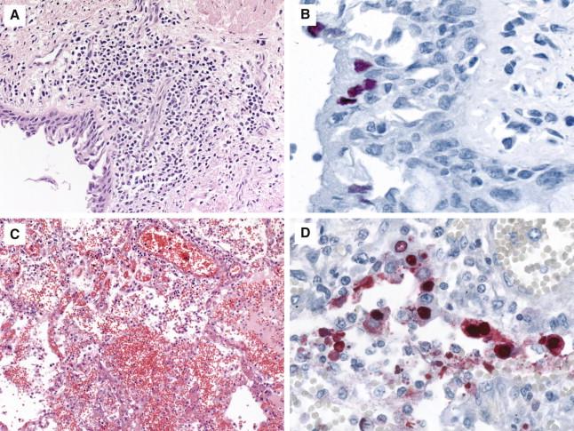 Figure 6-11, Histopathologic and immunohistochemical findings, in airways and lungs of fatal H1N1 cases. A, Mild mononuclear cell infiltration, in the lamina propria of the upper airway. B, Immunohistochemical staining of surface epithelial cell, in a serial section. C, Prominent intra-alveolar hemorrhage and interstitial pneumonitis (C) . D, Immunohistochemical staining of alveolar pneumocytes in a serial section. E, Early diffuse alveolar damage and interstitial pneumonitis. F, Immunohistochemical staining of influenza antigens of alveolar lining cells throughout this serial section. G, Advanced stage of diffuse alveolar damage, with prominent hyaline membranes in a patient with prolonged illness prior to death. H, Diffuse alveolar damage associated with a thrombotic vessel. Hematoxylin and eosin stain, original magnifications 25 × (A) , 12.5 × (C) , 25 × (E) , 12.5 × (G) , and 12.5 × (H) ; immunoalkaline phosphatase technique using monoclonal anti-influenza A virus antibody, stained with naphthol-fast red and counterstained with hematoxylin, original magnifications 100 × (B) , 100 × (D) , and 25 × (F) .