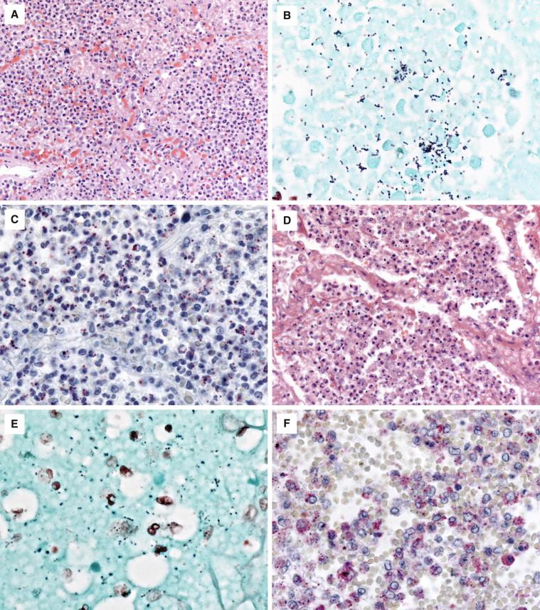 Figure 6-12, Bacterial pneumonias caused by streptococci and staphylococci in patients with fatal pandemic A (H1N1). Diffuse neutrophilic infiltrates and abundant gram-positive cocci in chains, showing specific staining by IHC for Streptococcus pyogenes (A-C) . Similar histopathologic features are seen in another patient with abundant gram-positive cocci in chains and pairs, showing IHC staining for Streptococcus pneumoniae (D-F) . Staphylococcus aureus is among the most common causes of concomitant bacterial pneumonia in patients with fatal influenza. S. aureus coinfections result in particularly destructive lesions characterized by diffuse necrosis and hemorrhage, as seen in this patient with fatal seasonal influenza B (G) . Abundant gram-positive cocci are readily identified in mats and clumps (H) , and stain specifically by using an IHC assay for S. aureus (I) . Hematoxylin and eosin stain, original magnifications 25 × (A) , 50 × (D) , and 12.5 × (G) ; Gram stain, original magnifications 158 × (B) , 158 × (E) , and 12.5 × (H) ; immunoalkaline phosphatase technique using monoclonal anti-influenza A virus antibody, stained with naphthol-fast red and counterstained with hematoxylin, original magnifications 100 × (C) , 100 × (F) , and 25 × (I) .