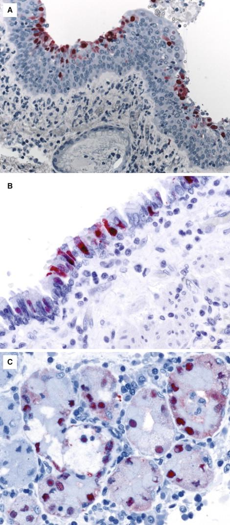 Figure 6-13, Immunohistochemical localization of seasonal influenza A and influenza B viral antigens in airway respiratory epithelial cells ( A and B ) and acinar cells of a submucosal gland (C) . Immunoalkaline phosphatase technique using monoclonal anti-influenza A virus antibody, stained with naphthol-fast red and counterstained with hematoxylin, original magnification 50 × (A) ; immunoalkaline phosphatase technique using monoclonal anti-influenza B virus antibodies, stained with naphthol-fast red and counterstained with hematoxylin, original magnifications 100 × ( B and C ).