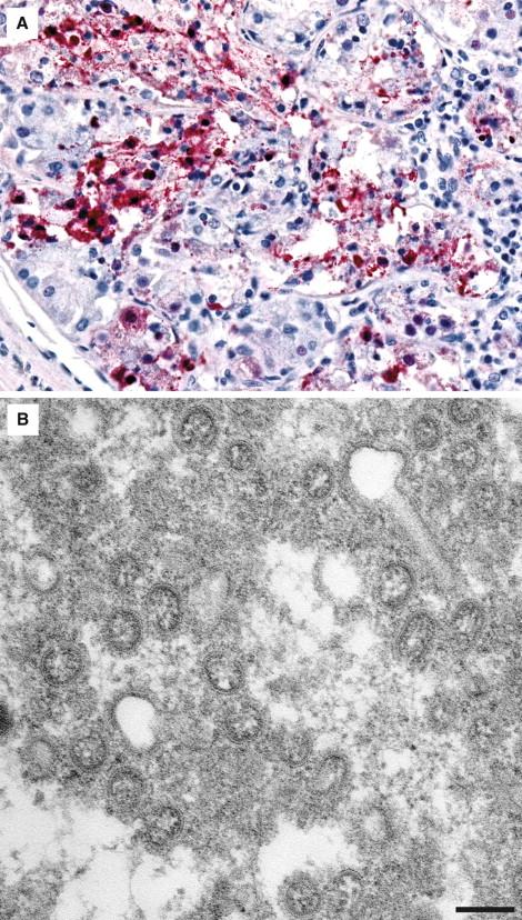Figure 6-14, In situ hybridization detection of pandemic influenza A (H1N1) viral nucleic acids showing both intranuclear and intracytoplasmic staining in a submucosal mucous gland (A) . Transmission electron micrograph showing aggregates of influenza virus particles in the submucosal gland in lung from a patient infected with pandemic influenza A (H1N1) virus. Virions are spherical and contain internal dots, which are cross sections through the nucleocapsids of the virus particles. Bar equals 100 nm (B) .