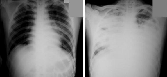 Figure 6-2, Progression of chest radiographic findings in a young man with a highly pathogenic avian influenza A (H5N1) virus infection. A, Chest x-ray on day 5 post-onset of illness. B, Chest x-ray on day 5 post-onset of illness. Patient was not ventilated and fully recovered.