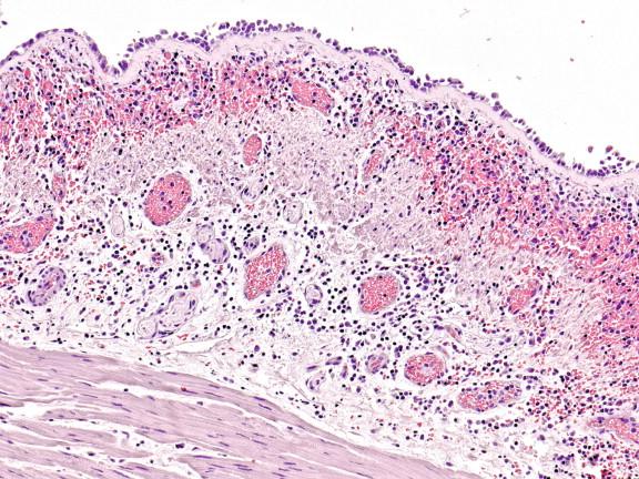 Figure 6-4, Bronchus of a child with fatal influenza B virus infection revealing prominent hemorrhage, congestion, edema, and diffuse mononuclear inflammatory cell infiltrates in the lamina propria. The surface is ulcerated but the basal layer of epithelium and basement membrane is largely preserved. Hematoxylin and eosin stain, original magnification 50 ×.