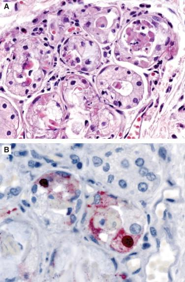 Figure 6-5, A, Submucosal gland from the trachea of a patient with a fatal influenza B virus infection showing multifocal necrosis of acinar cells. No conspicuous viral inclusions are identified, despite IHC evidence of infection (B) . Hematoxylin and eosin stain, original magnification 100 × (A) ; immunoalkaline phosphatase technique using monoclonal anti-influenza B virus antibodies, stained with naphthol-fast red and counterstained with hematoxylin, original magnification 158 × (B) .