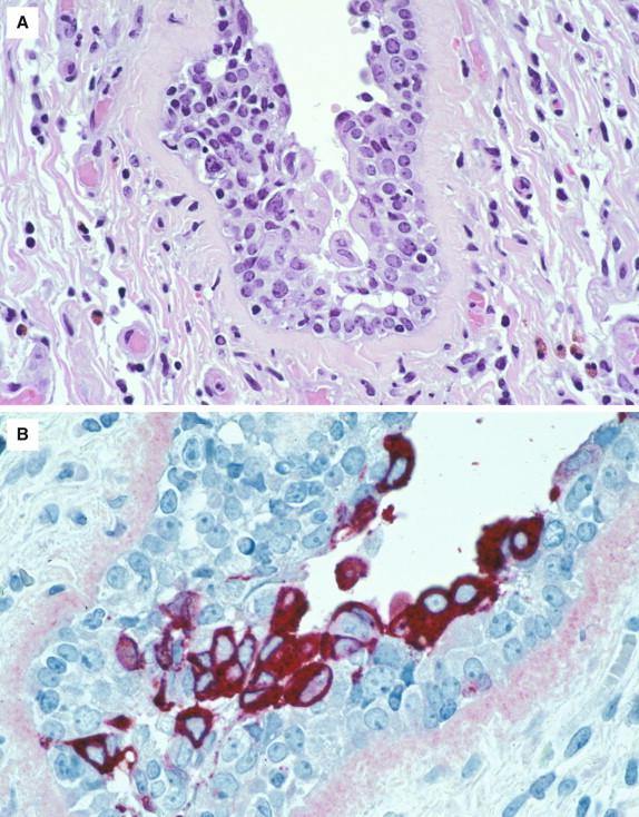 Figure 6-6, Unlike many other respiratory viral pathogens, influenza viruses do not form conspicuous intracellular inclusions. This is apparent in this image of involved airway exhibiting partially necrotic and inflamed respiratory epithelial cells (A) that lack inclusions, despite IHC evidence of extensive infection with seasonal influenza A virus (B) . Hematoxylin and eosin stain, original magnification 100 × (A) ; immunoalkaline phosphatase technique using monoclonal anti- influenza A virus antibody, stained with naphthol-fast red and counterstained with hematoxylin, original magnification 158 × (B) .