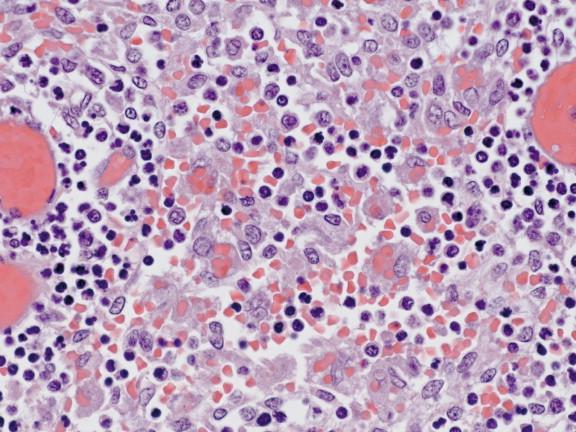 Figure 6-7, Erythrophagocytosis is identified frequently in lymph nodes adjacent to large airways, as seen in this section of parabronchial node from a patient with fatal influenza B virus infection. Hematoxylin and eosin stain, original magnification 100 ×.