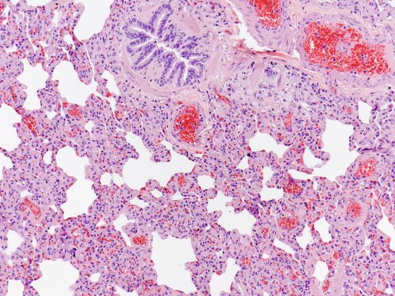 Figure 6-8, Interstitial pneumonia in a child with fatal influenza B virus infection. Hematoxylin and eosin stain, original magnification 25 ×.