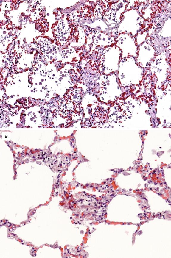 Figure 6-9, A, Early diffuse alveolar damage in a patient with fatal infection with seasonal influenza A virus. B, Alveolitis can be seen occasionally in the lungs of patients with severe infection with seasonal influenza, as identified in this patient with fatal influenza B. Hematoxylin and eosin stain, original magnifications 25 × (A) , and 50 × (B) .