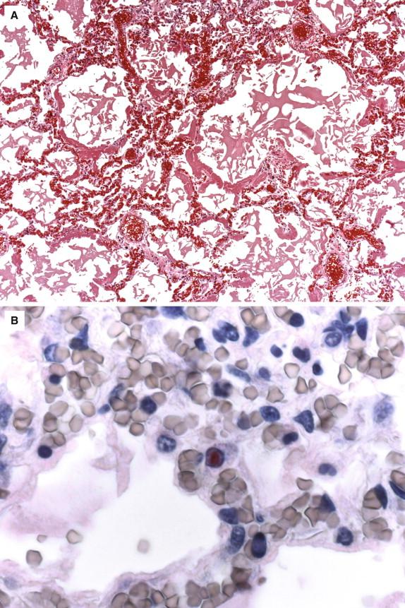 Figure 6-10, Histopathologic findings in a case of influenza A (H5N1) virus infection showing diffuse alveolar damage with prominent hyaline membrane formation (A) . Immunohistochemical analysis of lung shows a single epithelial cell containing intranuclear influenza A viral antigens (red) by using an antinucleocapsid antibody. Amplification of nucleic acid from this tissue specimen confirmed the presence of influenza A (H5N1) virus (B) . Hematoxylin and eosin stain, original magnification 25 × (A) ; immunoalkaline phosphatase technique using monoclonal anti-influenza A virus antibody, stained with naphthol-fast red and counterstained with hematoxylin, original magnification 158 × (B) .