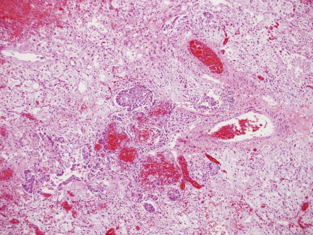 Fig. 119.1, Lung pathology of fatal case of primary influenza pneumonia in a previously healthy 20-year-old woman. Note diffuse alveolar filling, squamous metaplasia, lymphocytic infiltrates, and focal hemorrhage.