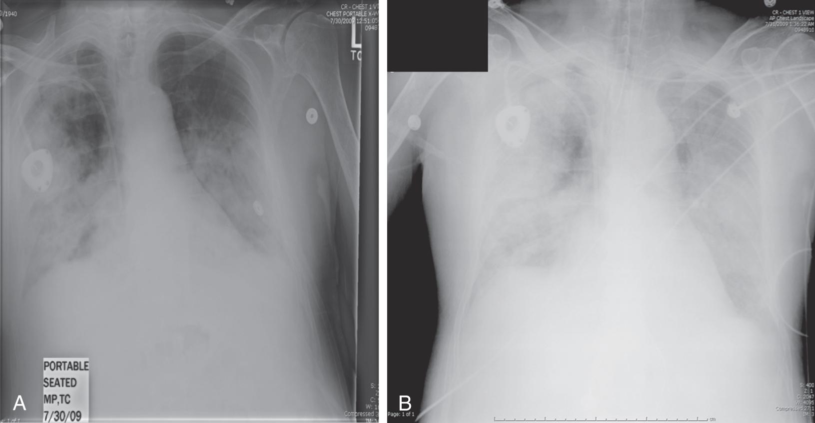 Fig. 119.2, A, Chest radiograph of a 70-year-old male with B-cell lymphoma and hypogammaglobulinemia in the ICU with primary influenza pneumonia. Note Port-a-Cath in right anterior chest wall and diffuse pulmonary infiltrates, most prominently seen in both lower lung fields. B, Chest radiograph of same patient 3 days later; note diffuse alveolar filling process associated with profound hypoxemia. The patient expired secondary to severe hypotension and acute kidney injury despite oseltamivir and intensive supportive care.