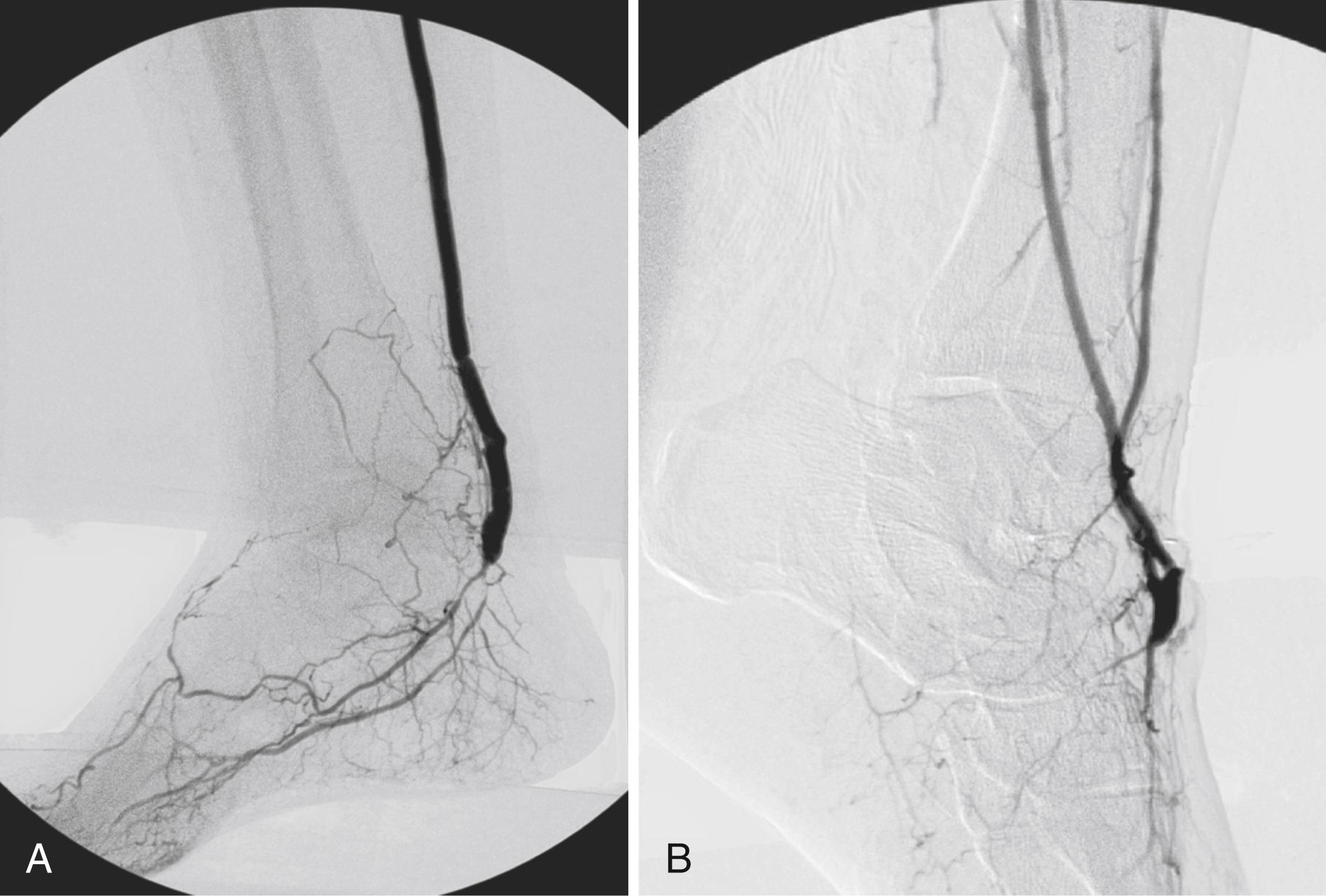 Figure 112.1, Detailed diagnostic arteriography with fixed imaging, proper timing, and appropriate catheter placement almost always identifies suitable target arteries. Each of the patients depicted had popliteal artery occlusion and extensive trifurcation and long-segment tibial disease, but diagnostic studies identified suitable target arteries in the foot. ( A ) Completion arteriogram after inframalleolar posterior tibial bypass in a patient with diabetes and forefoot gangrene. Despite a small-caliber outflow vessel, the bypass remains patent, and the ischemic foot ulcers healed and have not recurred at 2 years. ( B ) Completion arteriogram after bypass to a diseased dorsal pedal artery. Despite poor outflow and diseased arch and pedal vessels, the graft remains patent at 1 year. This patient with diabetes healed and ambulates with a transmetatarsal amputation.