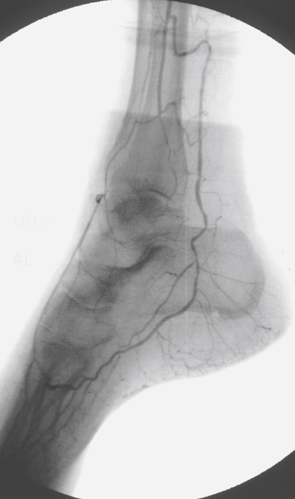 Figure 112.2, Lateral foot view obtained by distal selective superficial femoral arterial catheter injection identifies excellent collaterals from the distal peroneal artery to both the dorsal pedal and posterior tibial circulations.