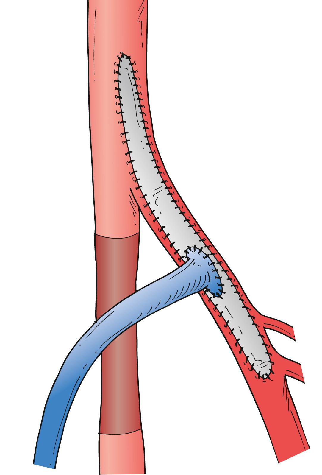 Figure 112.3, Linton vein patch technique after endarterectomy of the distal common and proximal deep femoral arteries, with anastomosis of the reversed vein graft to the patch.