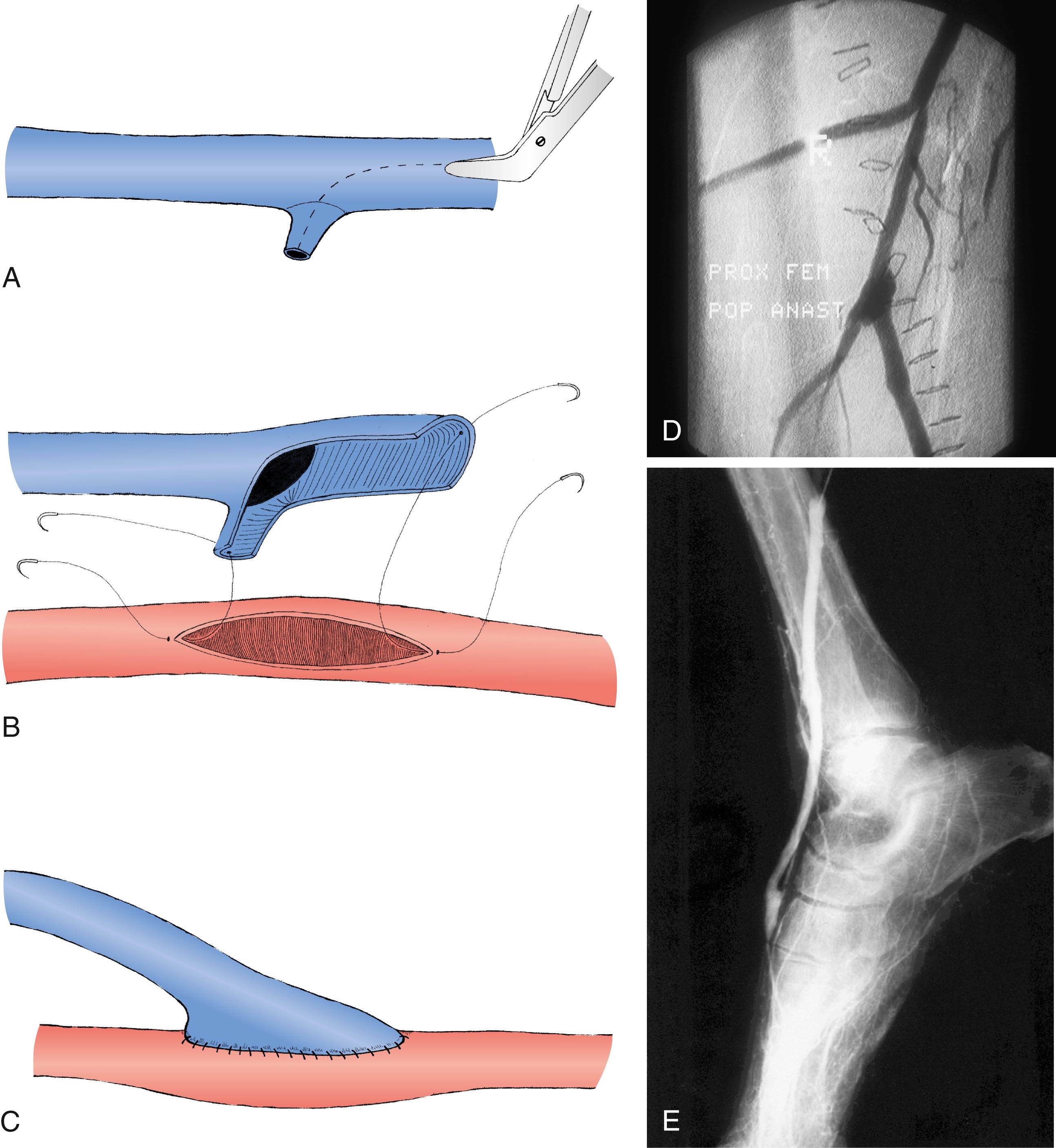 Figure 112.4, The venotomy through the reversed vein is extended through a suitable side branch ( A ) and anastomosed to the inflow artery ( B and C ) to avoid anastomotic stenosis at the graft heel. 37 , 72 This technique can be used at either the proximal anastomosis ( D ) or the distal anastomosis ( E ) and is useful when the vein caliber is small or the arterial wall is thickened.