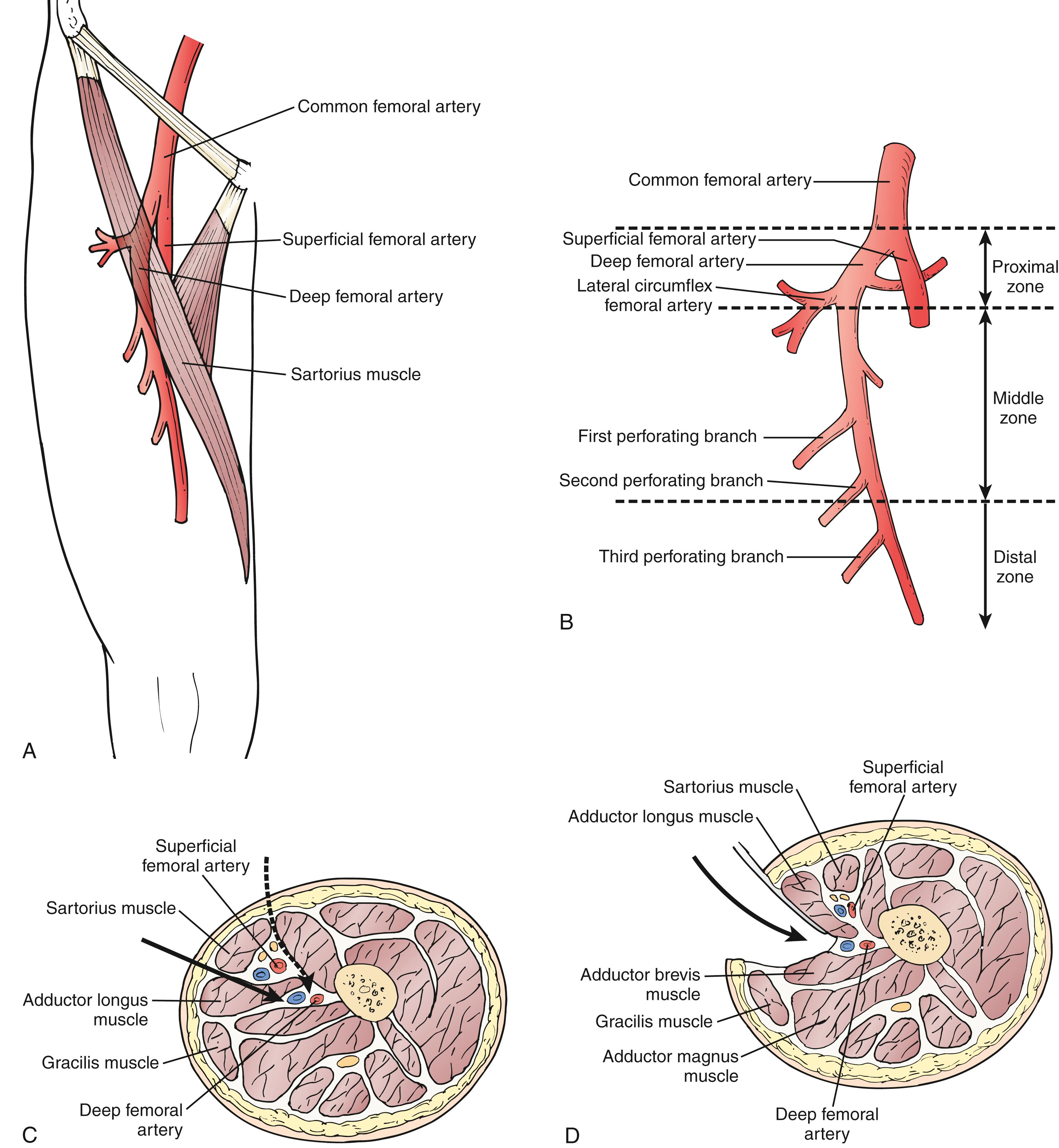 Figure 112.5, Alternative approaches to the distal deep femoral artery 88 are useful for reoperative femorodistal bypass and when it is desirable to shorten the bypass because of limited length of vein conduit. 89 ( A ) Location of the deep femoral artery. Note the surface landmarks used to identify its course. ( B ) The deep femoral artery can be divided into three zones: proximal, middle, and distal. ( C ) Transverse section of the thigh (viewed from above) shows the plane of dissection when the anteromedial approach (solid arrow) is used. Alternatively, the deep femoral artery can be approached through an even more anterior route (dashed arrow) by making an incision along the lateral border of the sartorius and retracting this muscle and the superficial femoral neurovascular bundle medially to reach the distal deep femoral artery. ( D ) Posterior approach to the distal deep femoral artery.