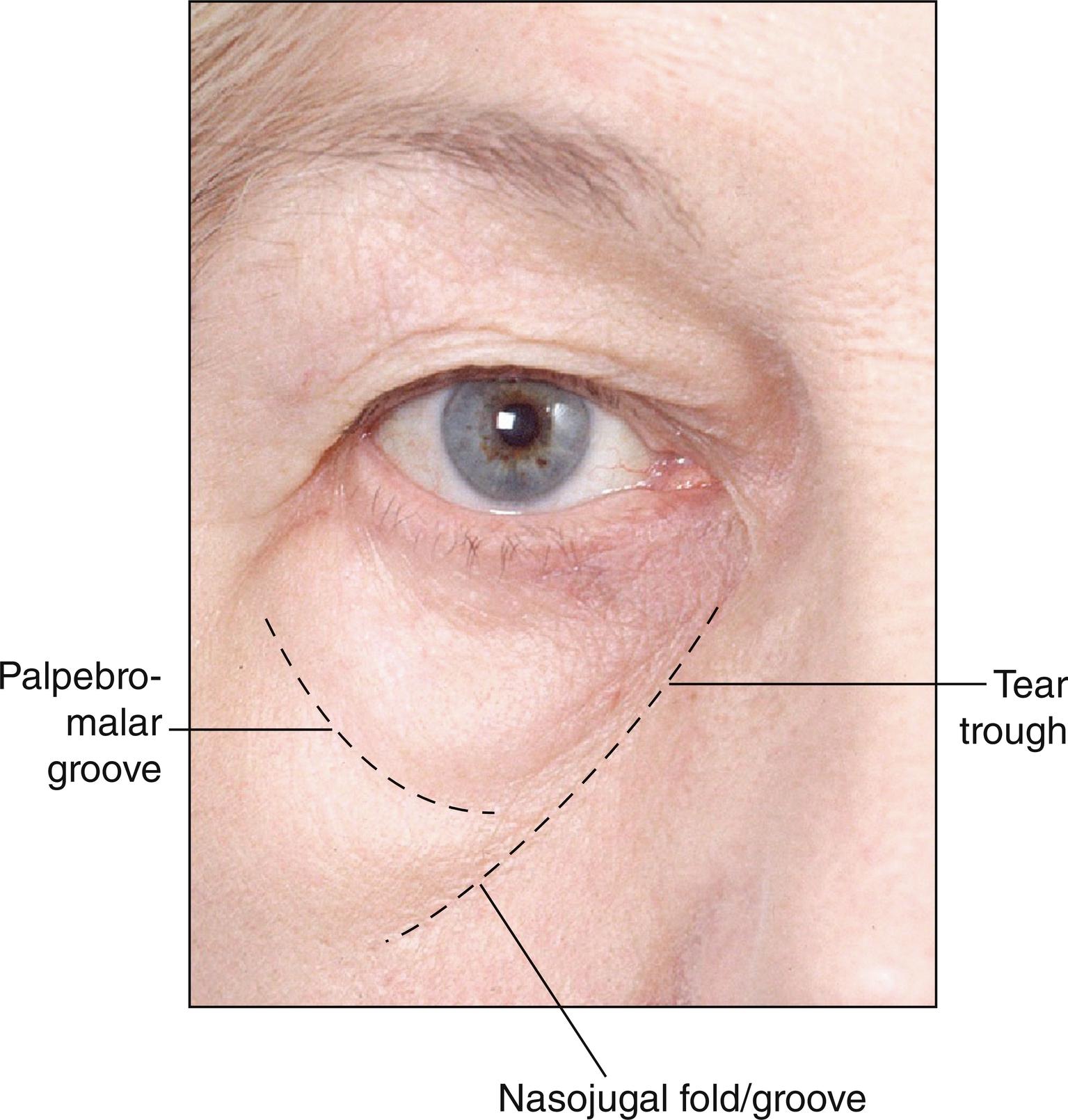 Fig. 20.1, Anatomy of the infraorbital hollow