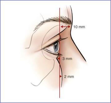 Fig. 8.1, Sagittal relations of the anterior surface of the cornea to the soft tissues overlying the supraorbital and infraorbital rims. On average, in the young adult, the supraorbital rim projects 10 mm beyond, the infraorbital rim lies 3 mm behind, and the cheek prominence projects 2 mm beyond the anterior surface of the cornea. 1 2 3 4