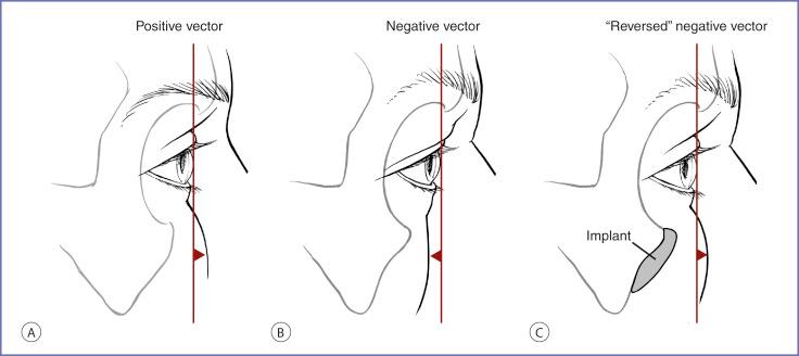 Fig. 8.2, Jelks and Jelks 5 categorized globe–orbital rim relationships by placing a line or “vector” between the most anterior projection of the globe and the soft tissues overlying the midface skeleton in the parasagittal plane. (A) Positive vector relationship. (B) Negative vector relationship. (C) “Reversed” negative vector relationship resulting from increasing the sagittal projection of the infraorbital rim with an implant.