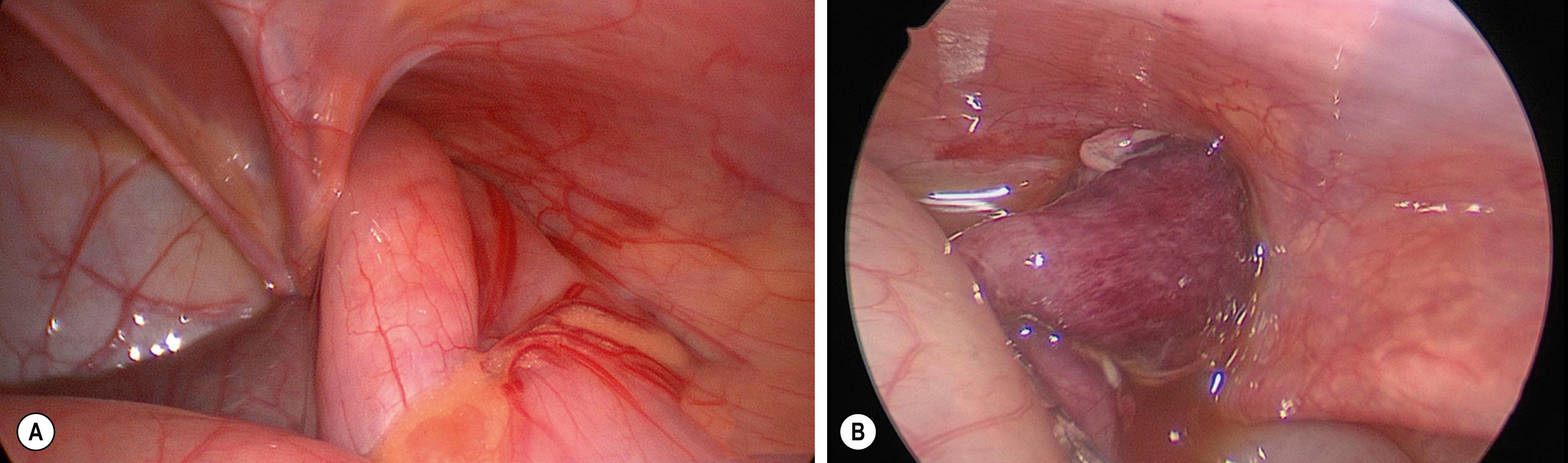 Fig. 50.11, These two infants underwent emergent laparoscopic repairs for incarcerated right inguinal hernias. On the left (A) the bowel could be reduced and a laparoscopic hernia repair was performed. On the right (B) the bowel was able to be reduced, but a short segment of it was infarcted. The bowel was exteriorized by enlarging the umbilical incision, and an extracorporeal bowel resection was performed. Both infants recovered uneventfully.