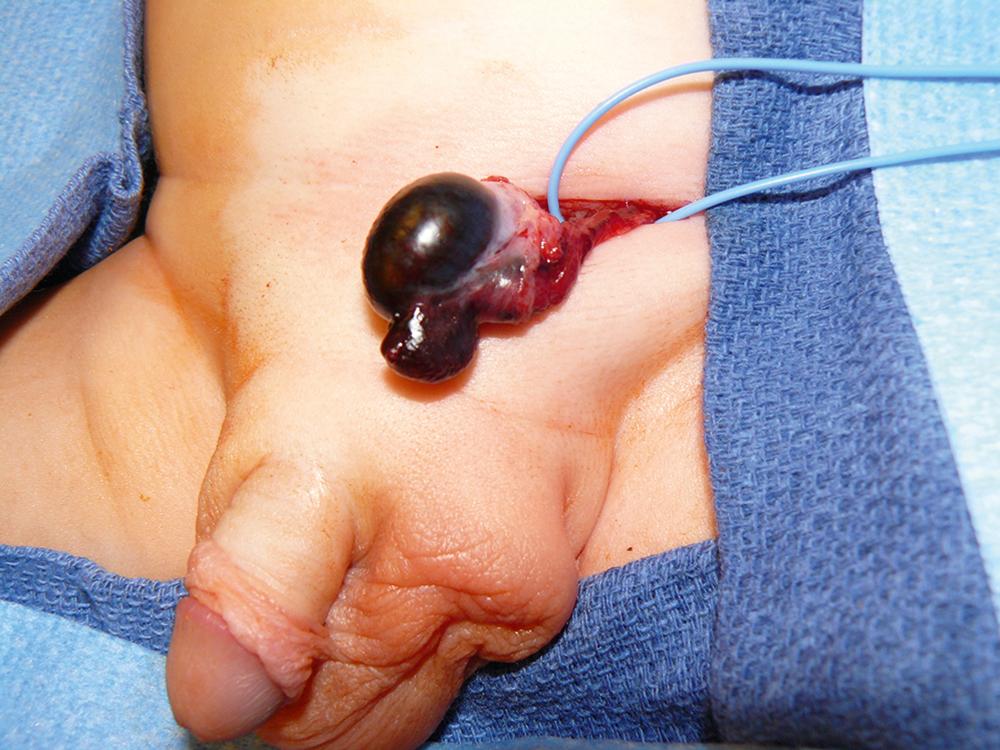 Fig. 50.12, This infant presented with an incarcerated left inguinal hernia and underwent an emergent operation. The bowel could be reduced and was viable. However, the left testis was infarcted due to the pressure from the incarcerated left inguinal hernia.