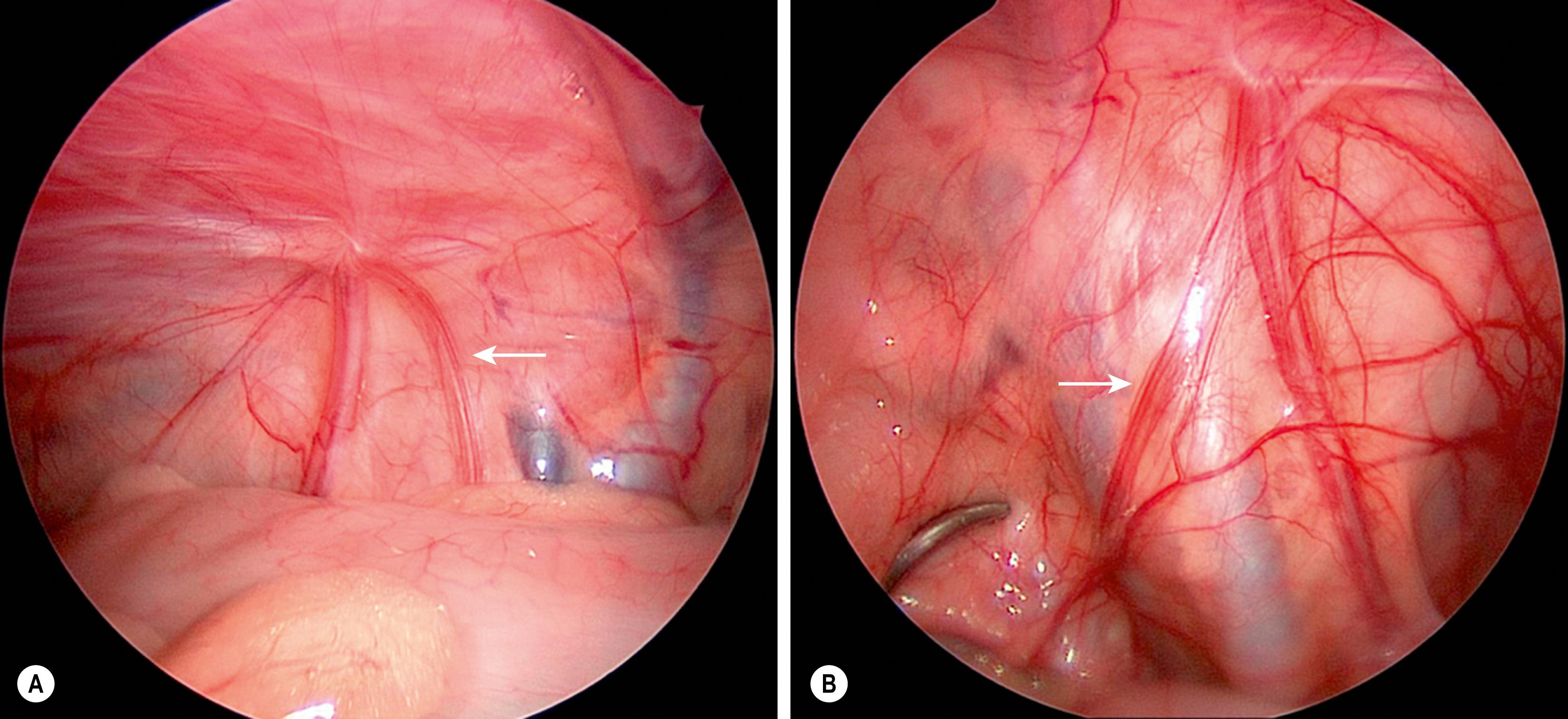 Fig. 50.2, This child with cystic fibrosis is undergoing diagnostic laparoscopy. Note the vas deferens (arrows) is atrophic on both sides. ( A ) Left, ( B ) Right. This is commonly seen in boys with cystic fibrosis.