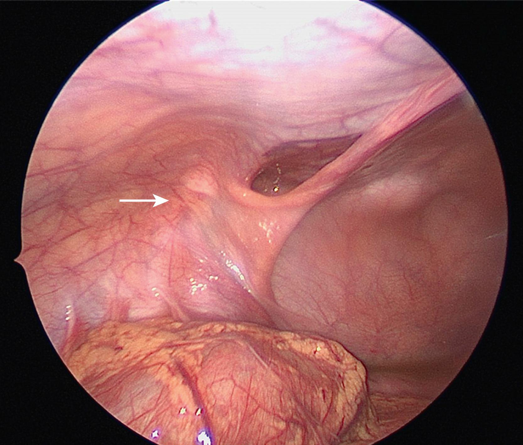 Fig. 50.3, This 15-year-old patient presented with a left inguino-femoral bulge that was suspicious for a left femoral hernia. The left femoral hernia was confirmed with diagnostic laparoscopy. She underwent a McVay repair and recovered uneventfully. Note the internal inguinal ring is closed (arrow).