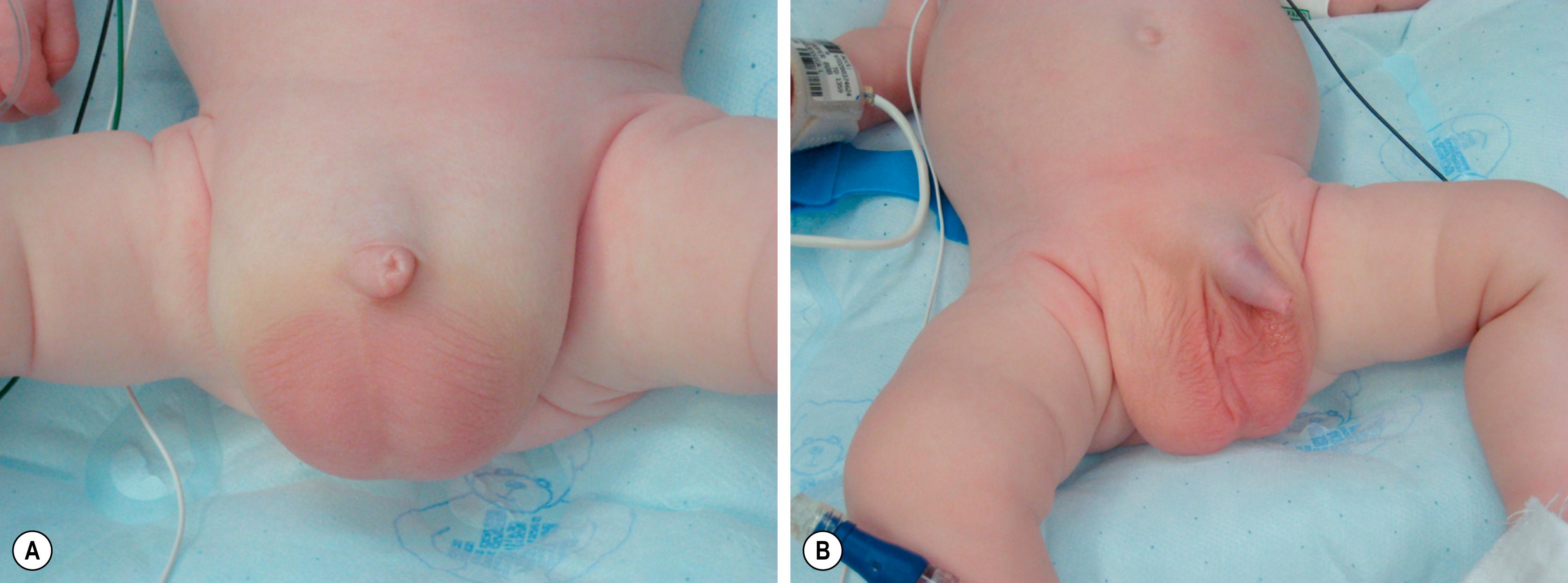 Fig. 50.7, This infant with bilateral inguinal hernias was placed on the operating room table. The large bilateral inguinal hernias are seen on the left (A) . Prior to prep and drape, the hernias were reduced (B).