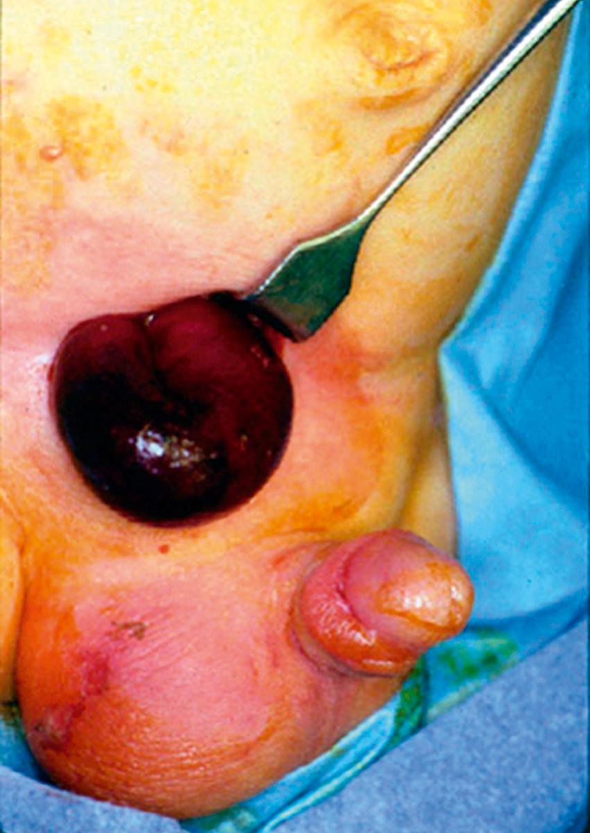 Fig. 50.10, This infant presented with a painful, tender right inguinal mass that could not be reduced. He was taken to the operating room emergently and found to have ischemia/infarction of a knuckle of small bowel. Through the inguinal incision, a short-segment bowel resection was performed with primary anastomosis. He recovered uneventfully.