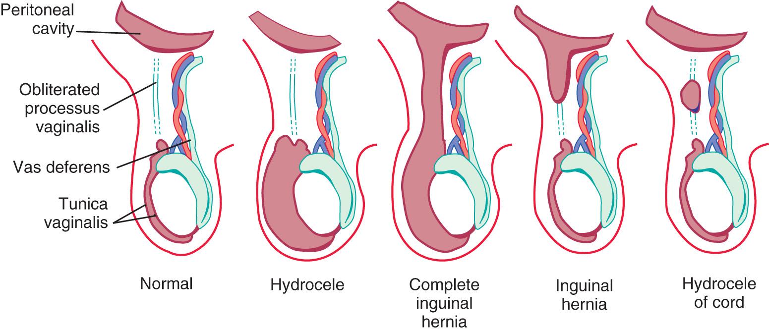 Fig. 373.1, Hernia and hydroceles.