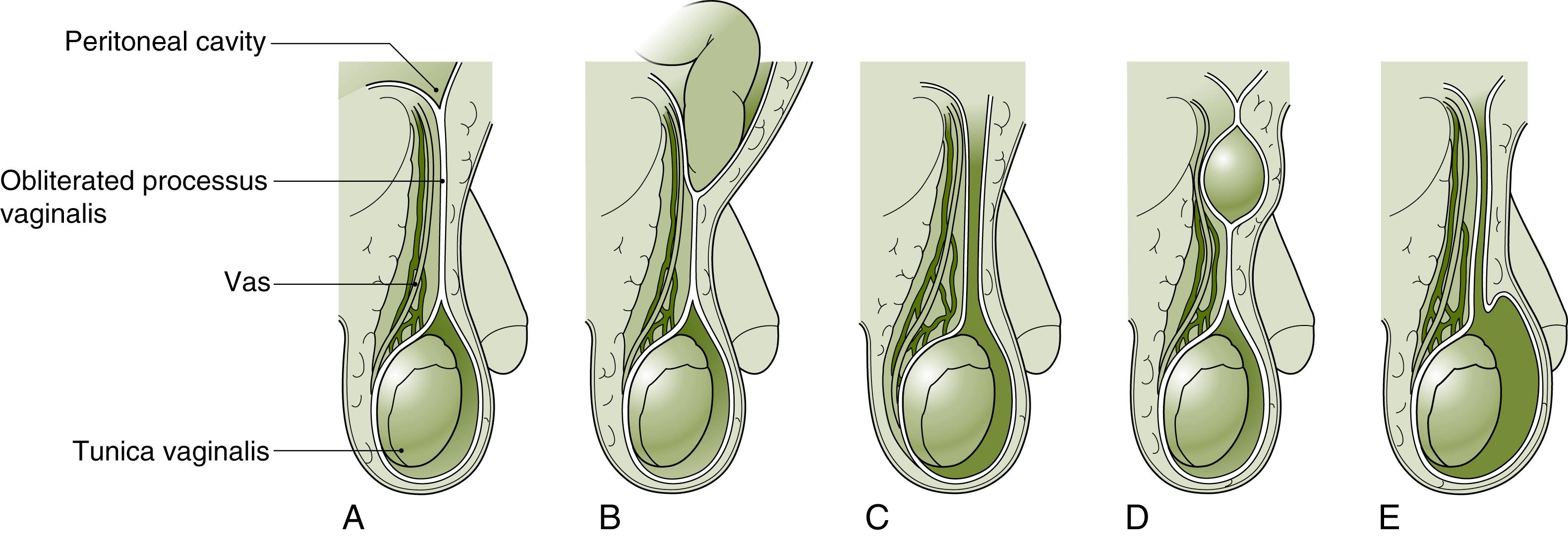 Fig. 52.1, Spectrum of Anatomic Abnormalities of the Processus Vaginalis.