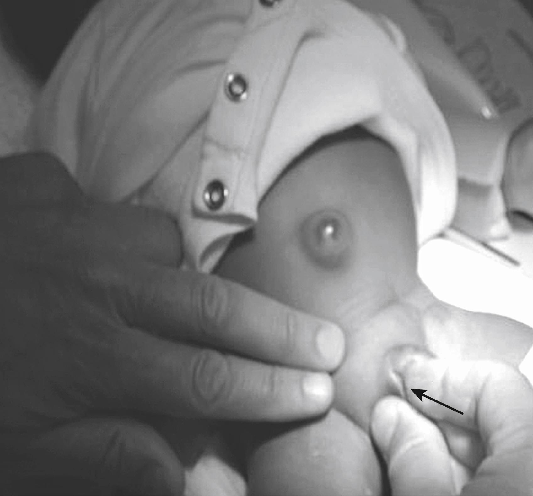 Fig. 52.4, Proper Technique in Reducing an Inguinal Hernia.