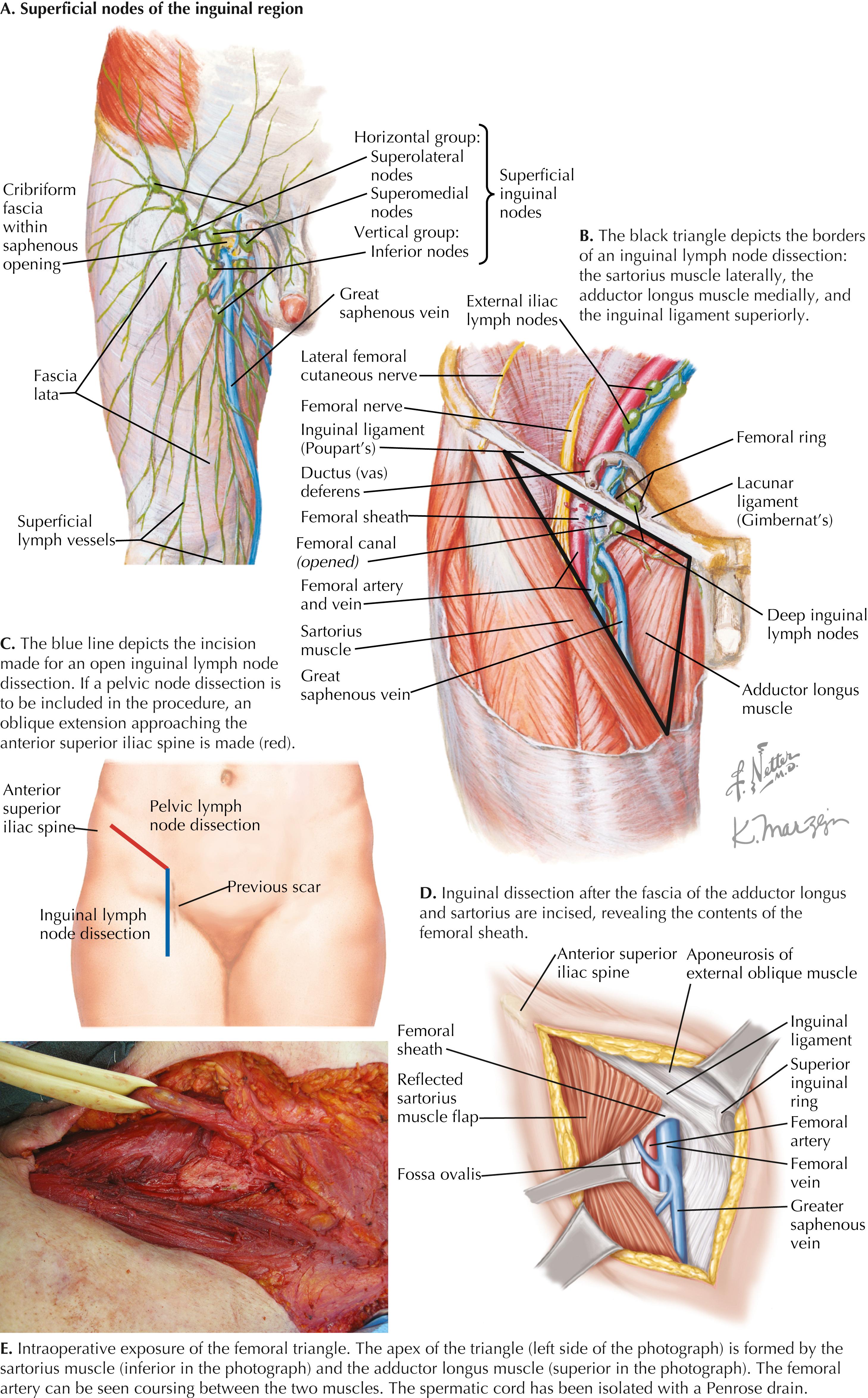 FIGURE 60.1, Inguinal lymph node dissection.