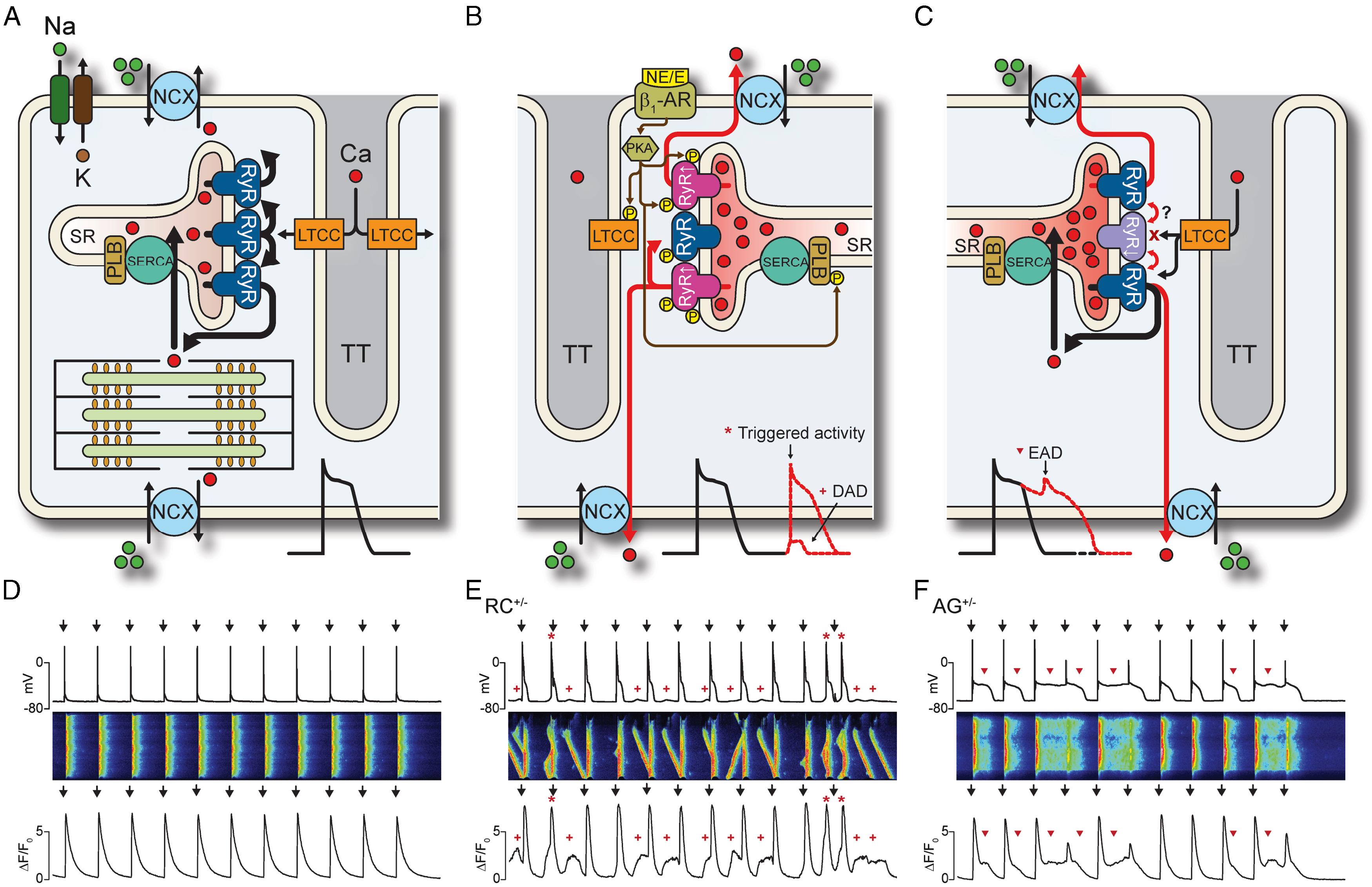 Fig. 51.1, Cellular mechanisms of catecholaminergic polymorphic ventricular tachycardia (CPVT).