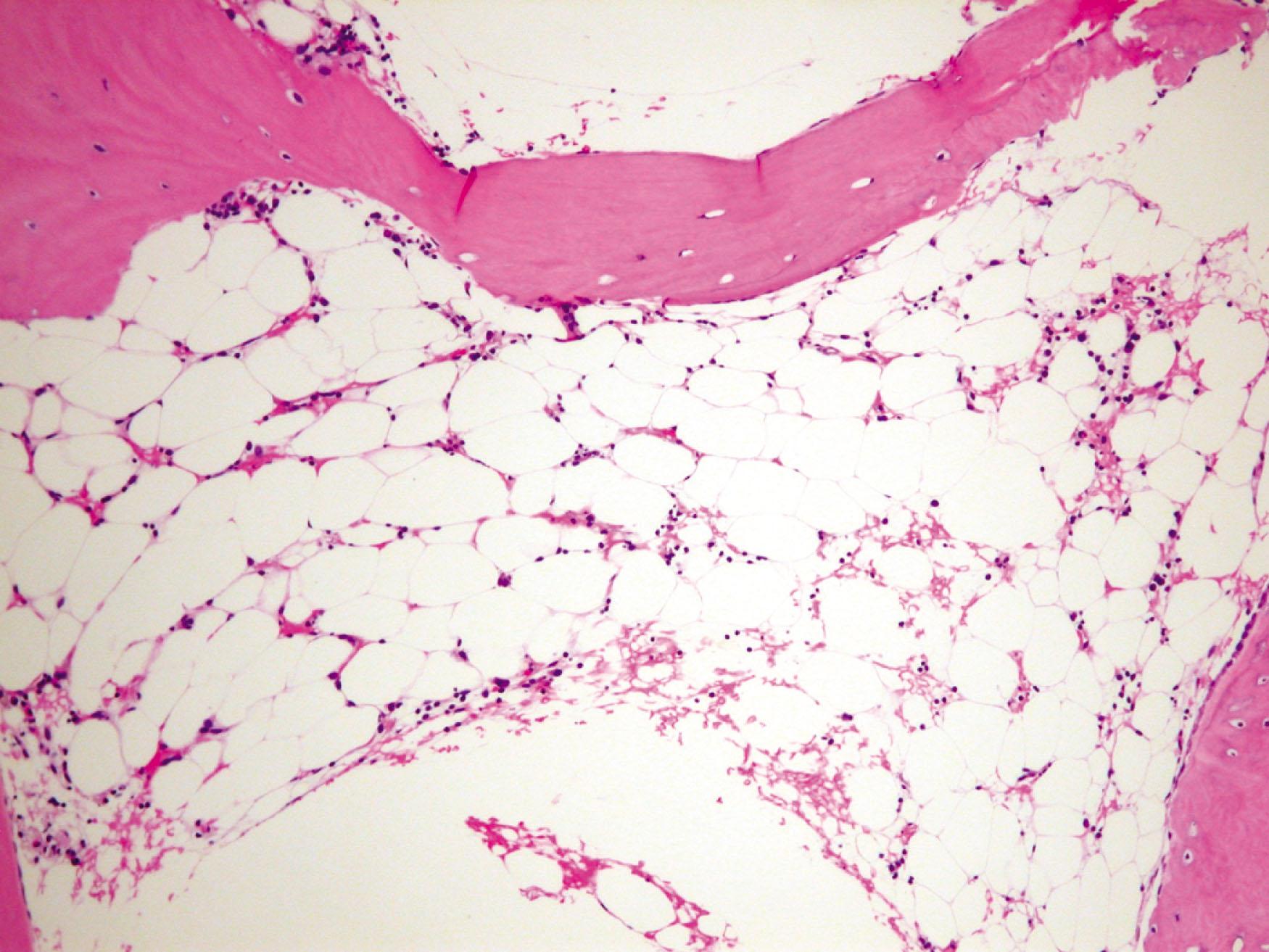 Figure 30.2, BONE MARROW BIOPSY IN SEVERE SHWACHMAN-DIAMOND SYNDROME SHOWING STRIKING HYPOCELLULARITY, FATTY CHANGES, AND TRILINEAGE APLASIA.