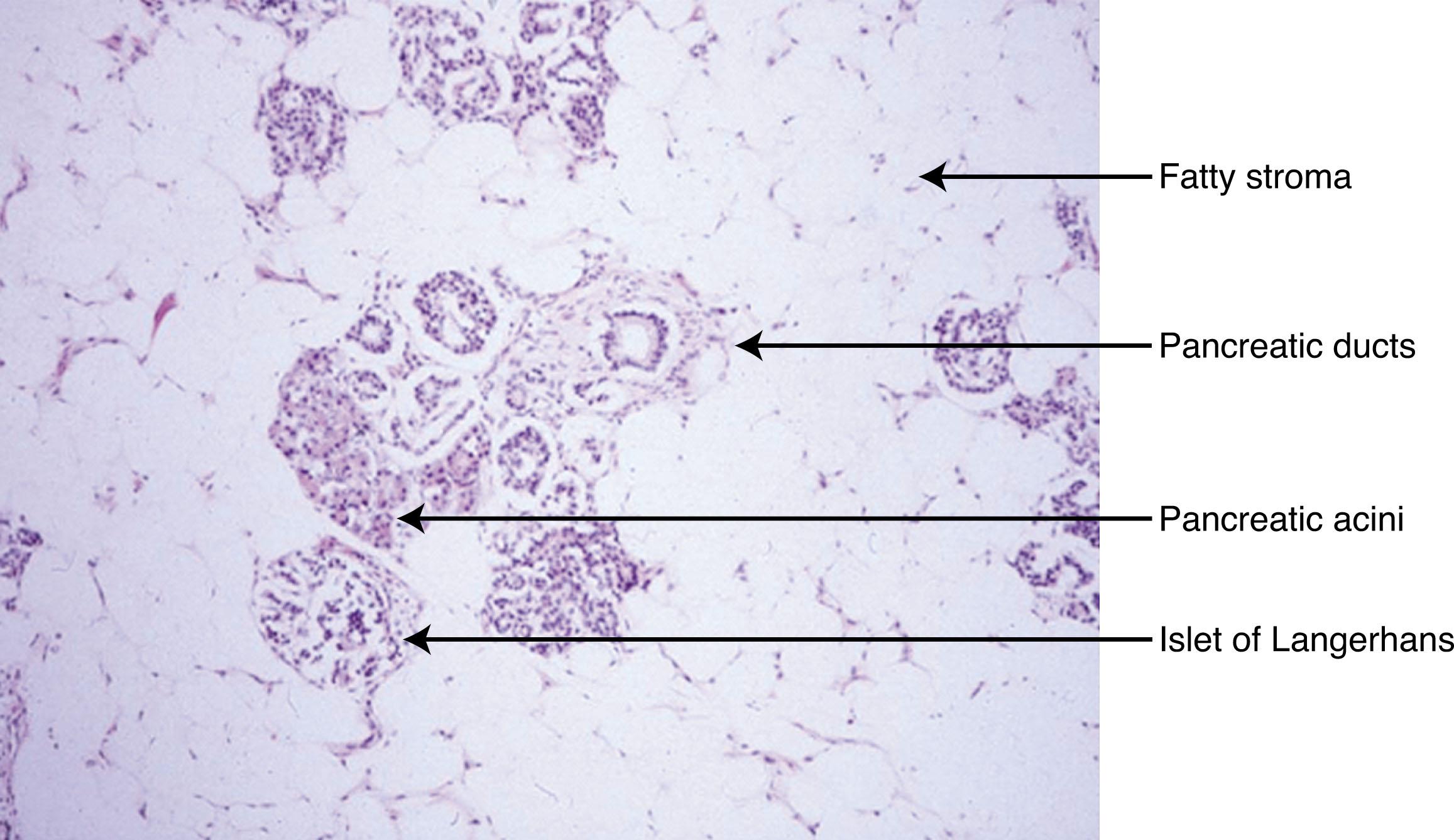 Figure 30.3, PANCREATIC TISSUE PATHOLOGY IN SEVERE SHWACHMAN-DIAMOND SYNDROME.