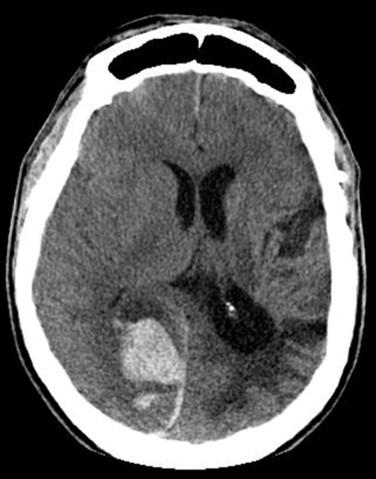 Fig 1, Cerebral amyloid angiopathy. CT scan showing large acute hemorrhage in the occipital region.