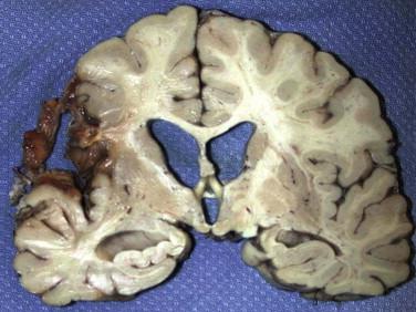 Fig 2, Cerebral amyloid angiopathy. Remote cerebral hemorrhage ( left ) with peripheral cortical cavitation and brown to yellow staining caused by hemosiderin deposition.