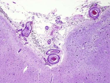 Fig 3, Cerebral amyloid angiopathy. Low-magnification view showing several superficial meningeal blood vessels that contain amorphous eosinophilic material.