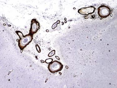 Fig 5, Immunohistochemical study showing a serial section of Figure 3 that exhibits extensive deposition of Aβ-amyloid peptide within several leptomeningeal blood vessels.