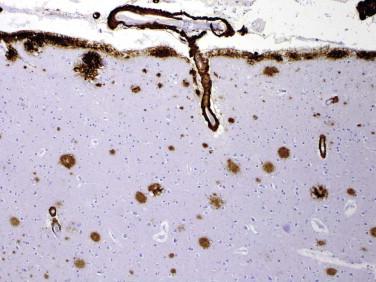 Fig 7, Immunohistochemical study showing extensive Aβ-amyloid reactivity within a superficial penetrating blood vessel and in neuritic plaques of the cerebral cortex.