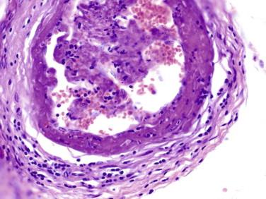 Fig 8, Aβ-amyloid–related angiitis (ABRA). Small superficial blood vessel with amorphous eosinophilic vascular amyloid and associated inflammatory changes.