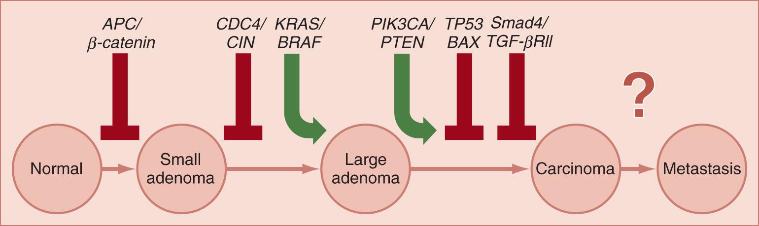 FIGURE 165.1, Classic chromosomal instability (CIN) and multistep carcinogenesis. The classic multistep carcinogenesis model proposed in 1990 has been repeatedly confirmed over the decades. The initial step is the disruption of WNT signaling, either by loss of adenomatous polyposis coli (APC) or a “downstream” event that achieves the same result. The adenoma can remain small indefinitely, but if it acquires additional mutations that activate proto-oncogenes, they become larger and more dysplastic. The loss of p53 is the most common event at the adenoma-to-carcinoma transition. Initially, colorectal cancers (CRCs) may have minimal ability to metastasize, but the accumulation of additional mutations or other alterations eventually permits tumor cells to escape the primary tumor mass and grow at a distant site. TGF-β , Transforming growth factor beta.