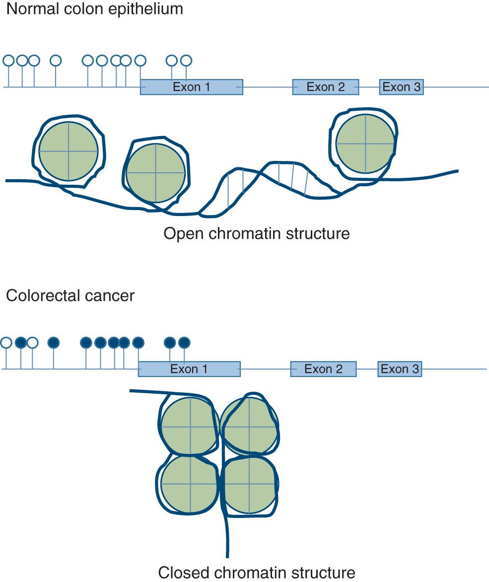 Figure 165.3, CIMP and methylation-induced silencing of genes. A gene is depicted as a line with three (blue) exons and multiple CpG sites indicated by circles on sticks; white circles are unmethylated cytosines and blue circles are methylated. The CpG sites are clustered just to the left of the start site of the gene and in the first exon. At the top, the unmethylated CpG sites leave the chromatin “open” and available to transcription factors for gene expression. After the methylation of the cytosines in a CIMP-CRC (lower panel) , the closed chromatin structure silences gene expression. Only the CpG clusters in the promoter and first exon are important for gene silencing as shown here. 6 β-cat , β-catenin; βTrCP , β-transducin repeats-containing proteins; APC , adenomatous polyposis coli gene; Axin , part of the APC-containing complex; CK1 , casein kinase-1; Dvl , disheveled; GSK3 , glycogen synthase kinase-3.