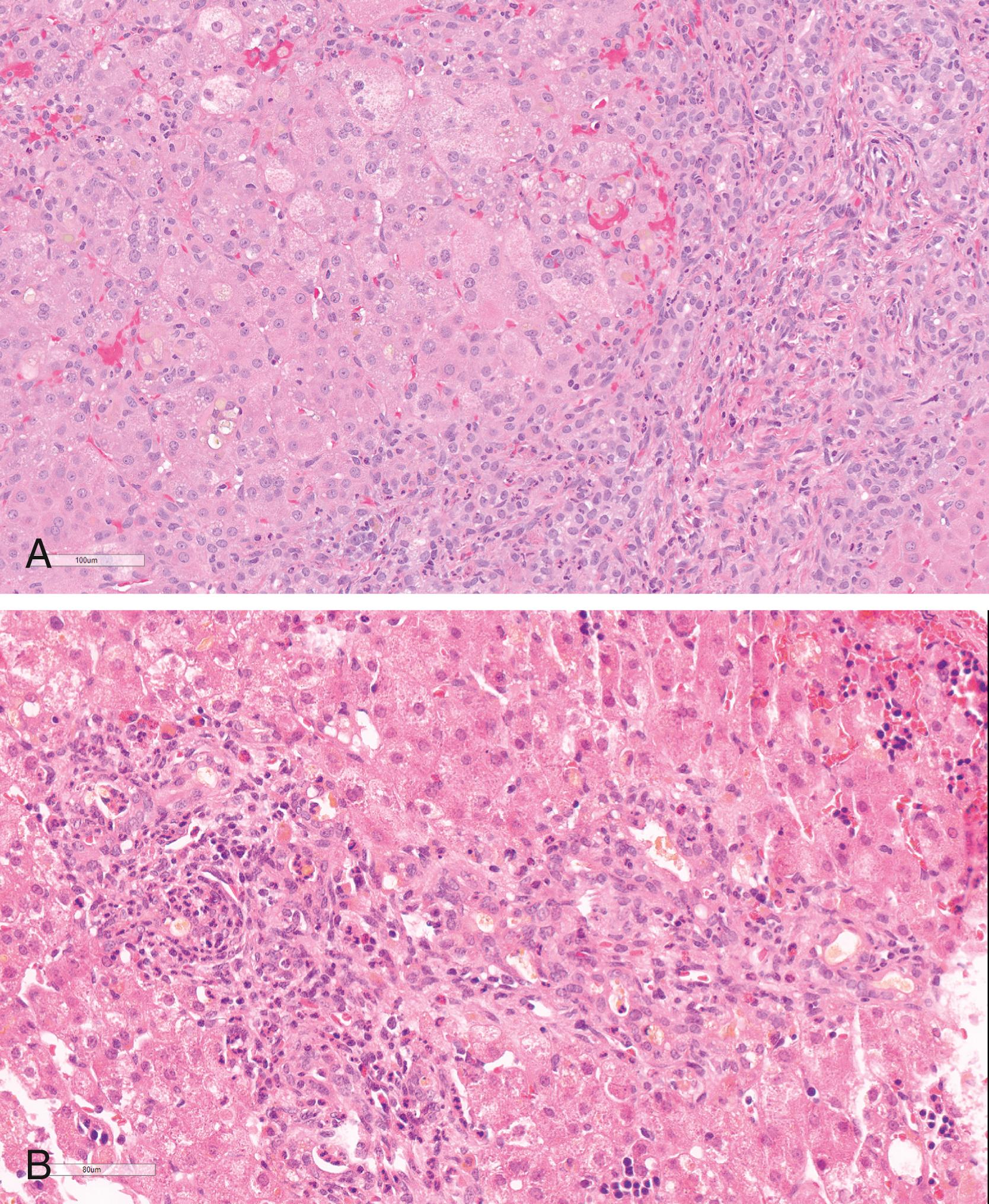 FIGURE 55.4, Lobular changes of “neonatal hepatitis” in extrahepatic biliary atresia.