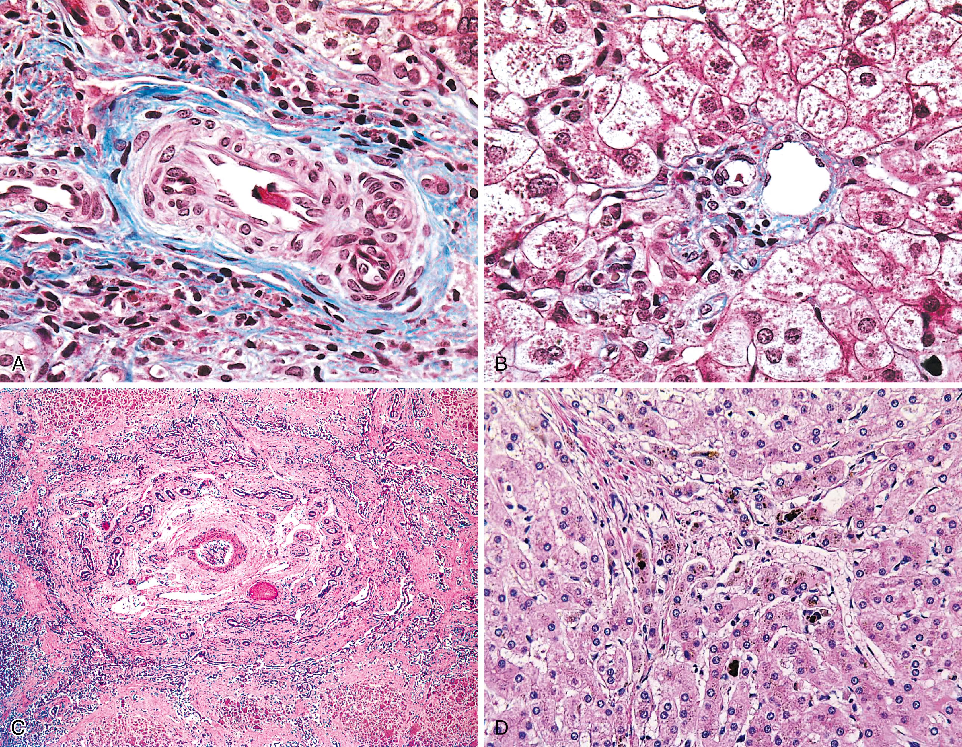 FIGURE 55.5, Nonclassic features of portal tracts in extrahepatic biliary atresia.