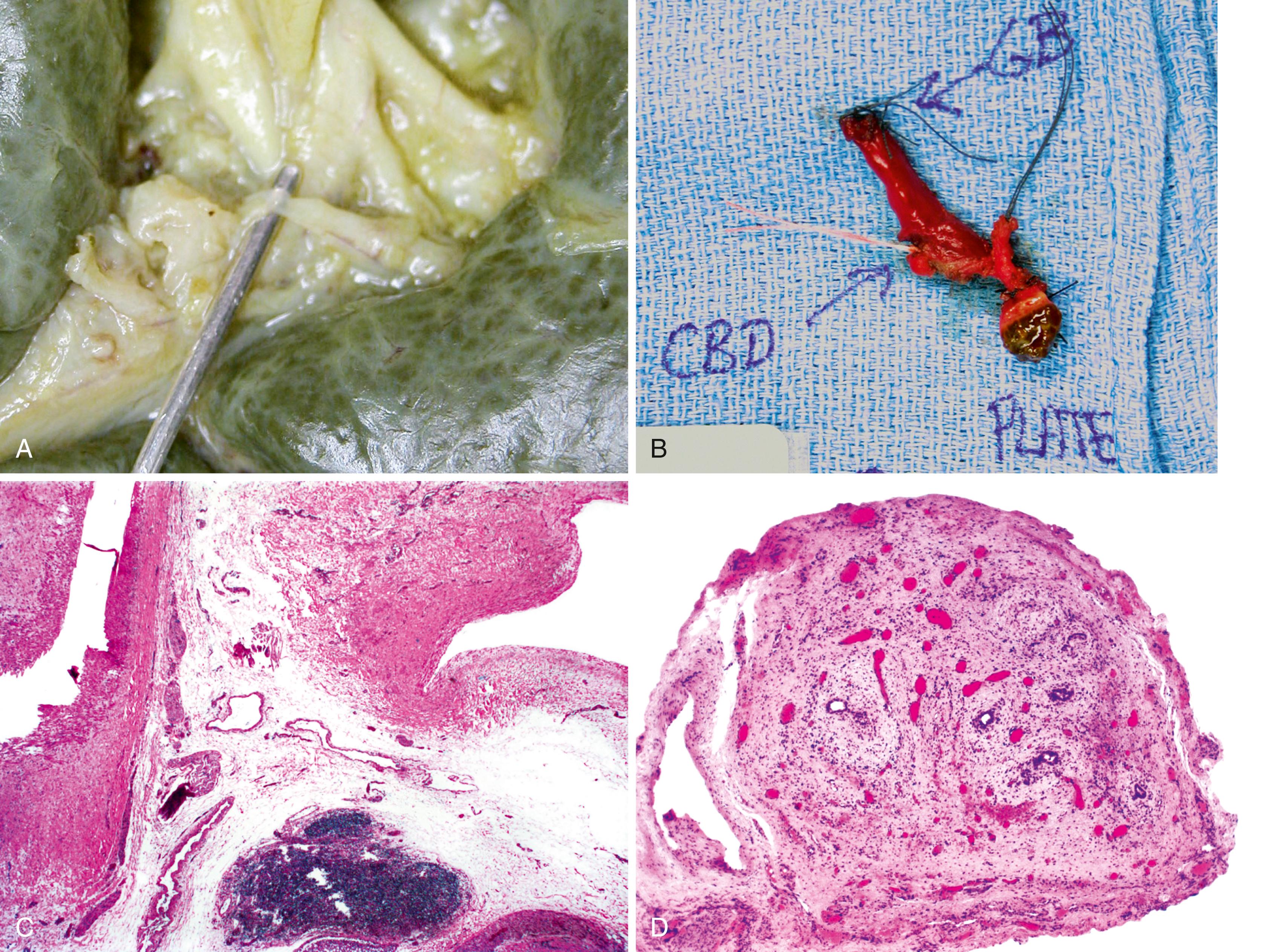 FIGURE 55.6, Biliary atresia at surgery.