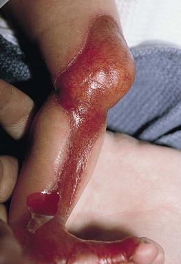 Figure 11.2, Congenital localized absence of skin can be seen in all types of EB.